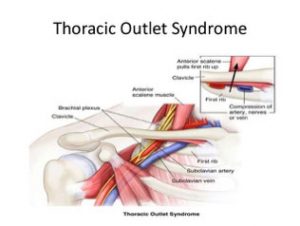 Vascular Thoracic Outlet Syndrome - ScienceDirect